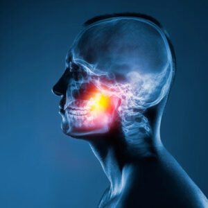 Trigeminal Nevralji