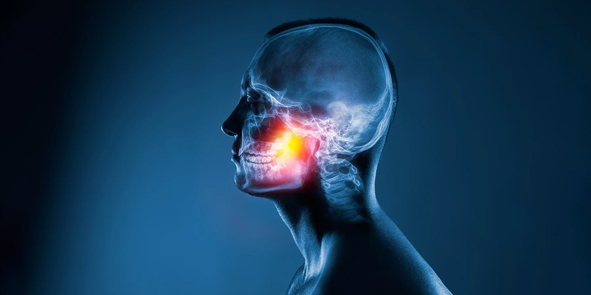 Trigeminal Nevralji
