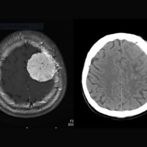 Meningiomlar