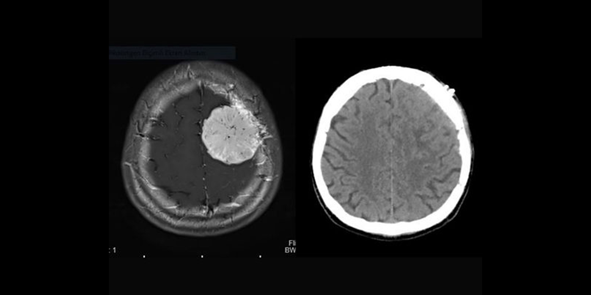 Meningiomlar